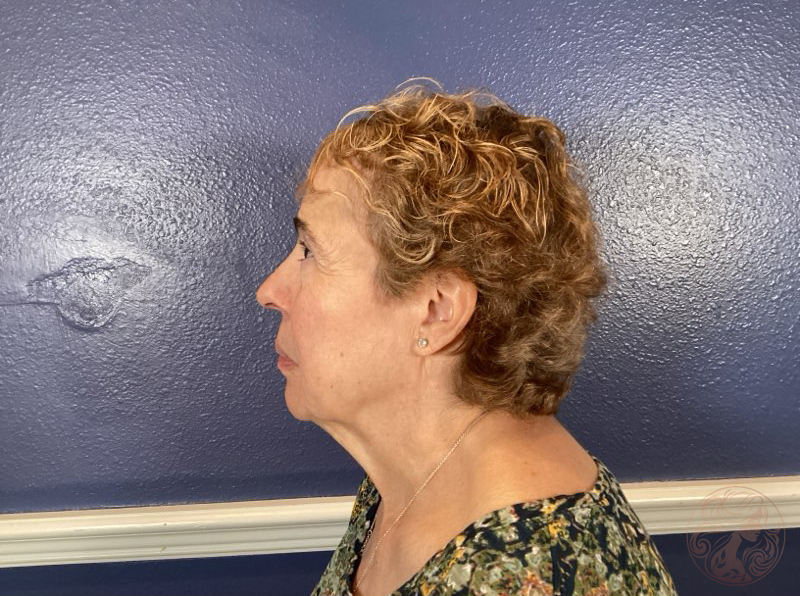 Before treatment side view showing jawline sagging, neck fullness, and eyelid laxity. Viradia Plastic Surgery.
