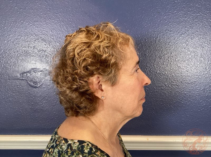 Before angled view showing facial laxity and uneven skin tone.