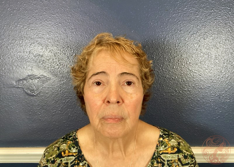 Before profile view showing chin fullness and neck laxity.