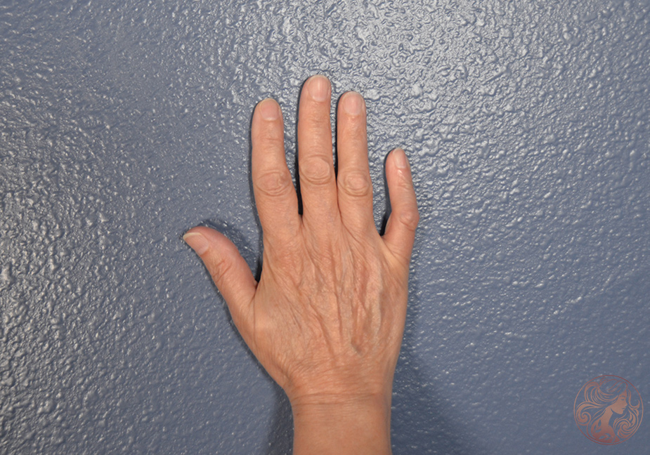 Before showing facial aging and volume loss in hands.