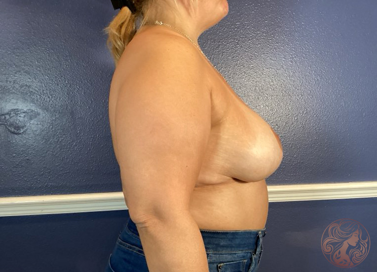 Breast implant removal with capsule excision, after treatment, angled view showing a more relaxed breast shape and natural contour. Viradia Plastic Surgery.