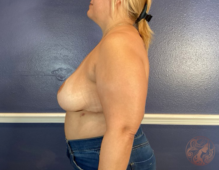 Breast implant removal with capsule excision, after treatment, angled view showing a more natural, balanced breast contour. Viradia Plastic Surgery.