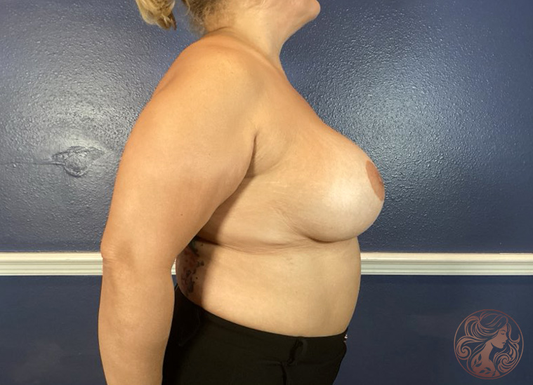 Breast implant removal with capsule excision, before treatment, angled view showing breast implants with a fuller, more augmented contour. Viradia Plastic Surgery.