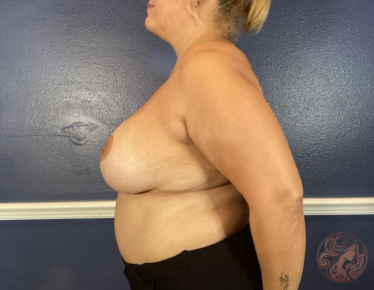 Breast implant removal with capsule excision, before treatment, angled view showing implants affecting breast shape and firmness. Viradia Plastic Surgery.