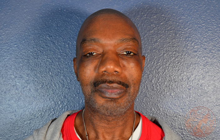 Lower blepharoplasty with chin implant, after treatment, front view showing smoother under-eye contour and improved chin projection. Viradia Plastic Surgery.