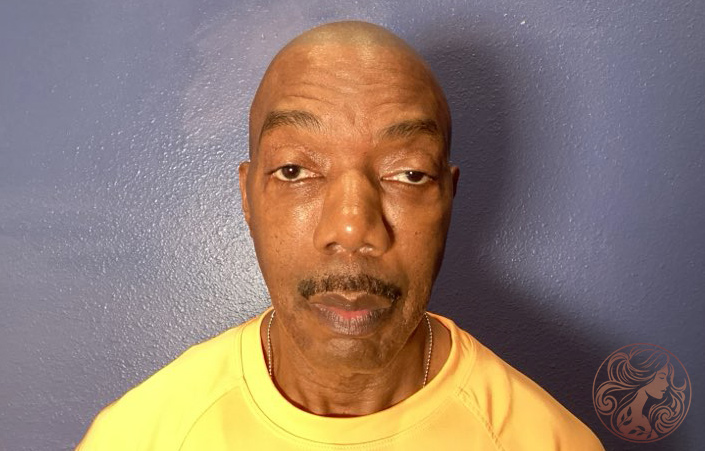 Lower blepharoplasty with chin implant, before treatment, front view showing under-eye puffiness and a slightly recessed chin. Viradia Plastic Surgery.