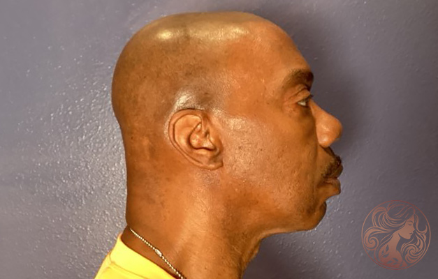 Lower blepharoplasty with chin implant, before treatment, side view showing under-eye fullness and a weak chin profile. Viradia Plastic Surgery.