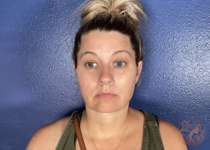 Chin and neck liposuction with Botox patient, after treatment, front view. Viradia Plastic Surgery.