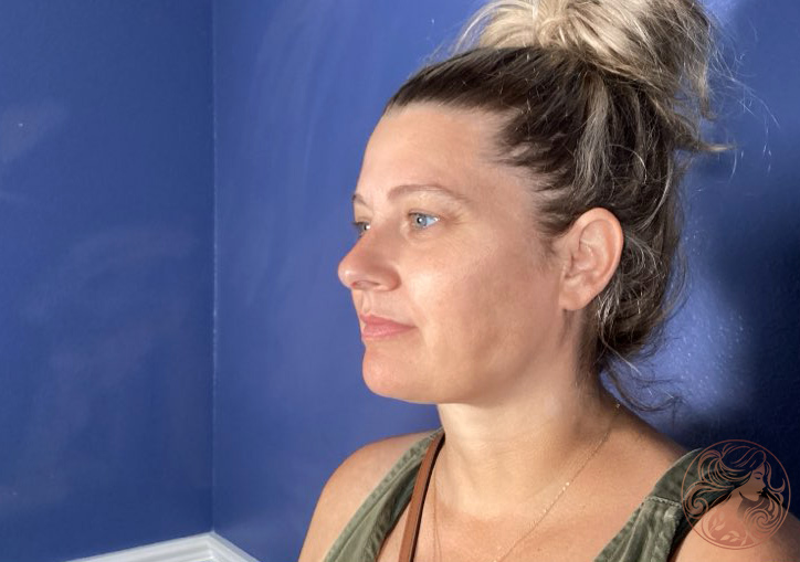 Chin and neck liposuction with Botox patient, after treatment, left three-quarter view. Viradia Plastic Surgery.