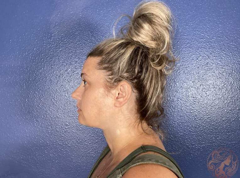 Chin and neck liposuction with Botox patient, after treatment, left profile view. Viradia Plastic Surgery.