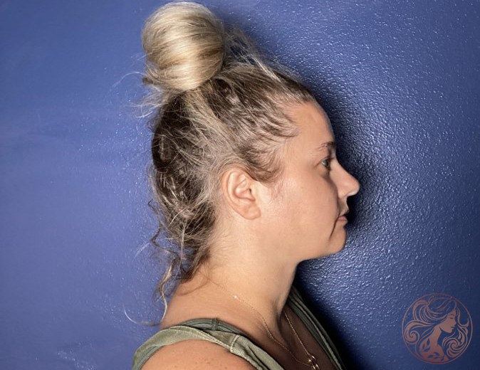 Chin and neck liposuction with Botox patient, after treatment, right profile view. Viradia Plastic Surgery.