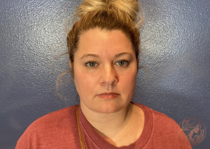 Chin and neck liposuction with Botox patient, before treatment, front view. Viradia Plastic Surgery.