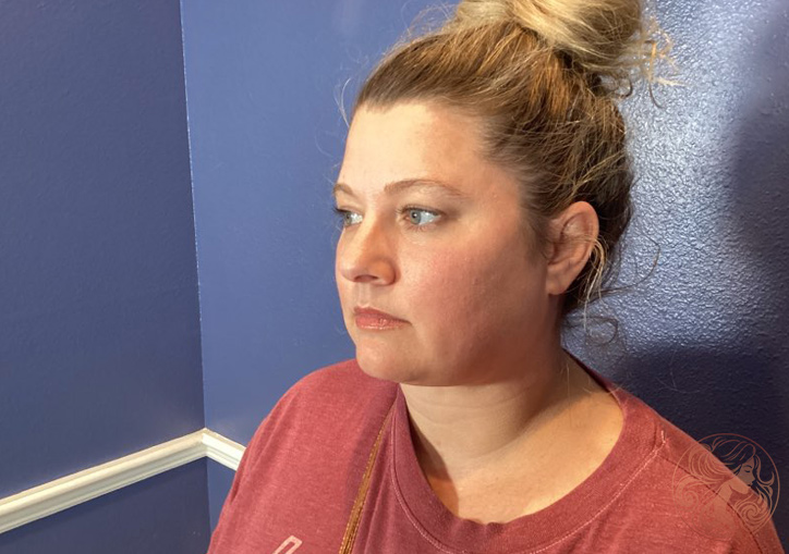 Chin and neck liposuction with Botox patient, before treatment, left three-quarter view. Viradia Plastic Surgery.