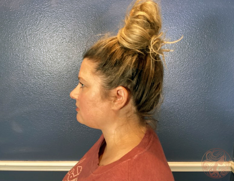 Chin and neck liposuction with Botox patient, before treatment, left profile view. Viradia Plastic Surgery.