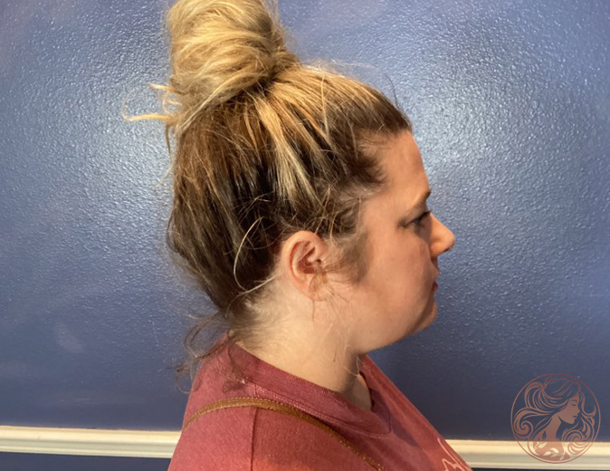 Chin and neck liposuction with Botox patient, before treatment, right profile view. Viradia Plastic Surgery.