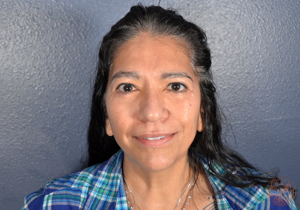 Blepharoplasty with brow lift, after treatment, front view showing smoother eyelids, reduced under-eye fullness, and a more elevated brow position. Viradia Plastic Surgery.