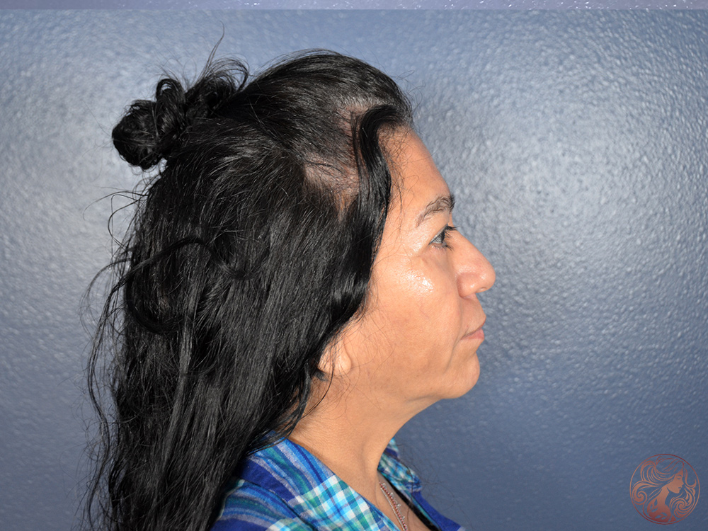 Blepharoplasty with brow lift, after treatment, angled view showing smoother eyelids, reduced under-eye fullness, and lifted brow contour. Viradia Plastic Surgery.