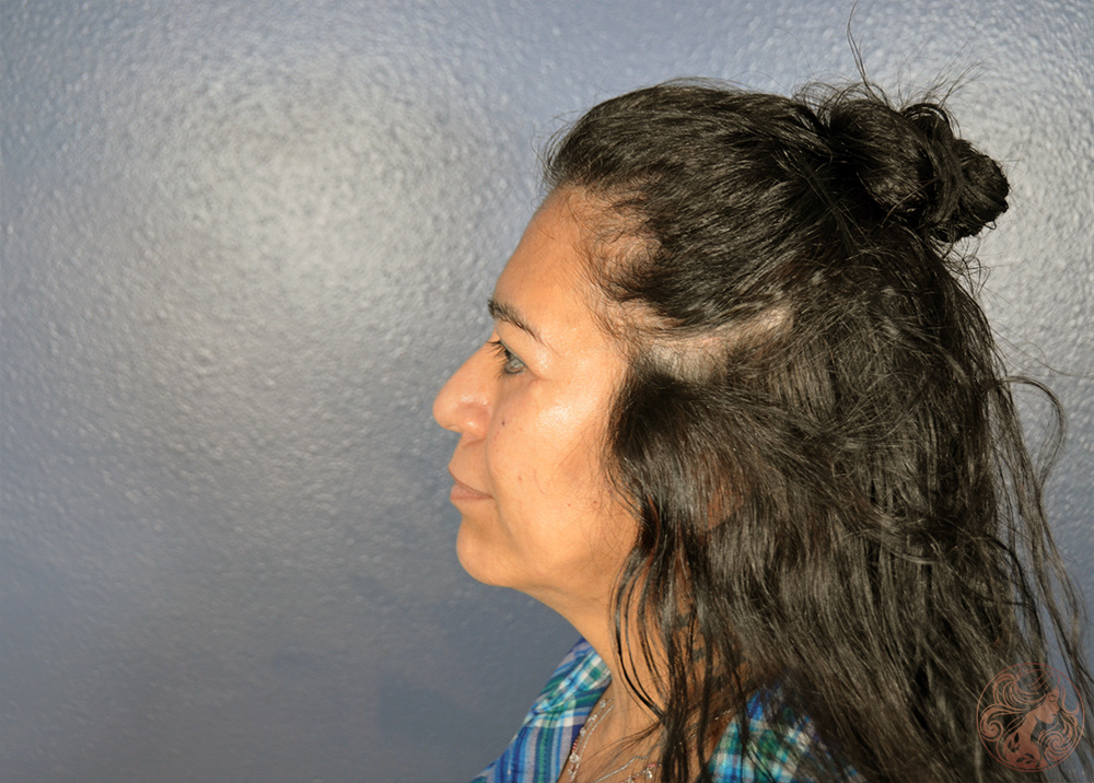 Blepharoplasty with brow lift, after treatment, side view showing improved eyelid contour and a more elevated brow. Viradia Plastic Surgery.