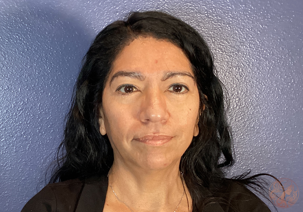 Blepharoplasty with brow lift, before treatment, front view showing eyelid heaviness, under-eye fullness, and mild brow descent. Viradia Plastic Surgery.