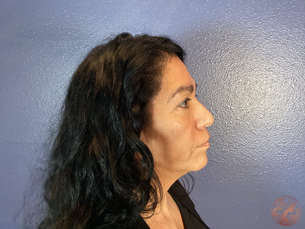 Blepharoplasty with brow lift, before treatment, angled view showing drooping eyelids, under-eye bags, and brow descent. Viradia Plastic Surgery.