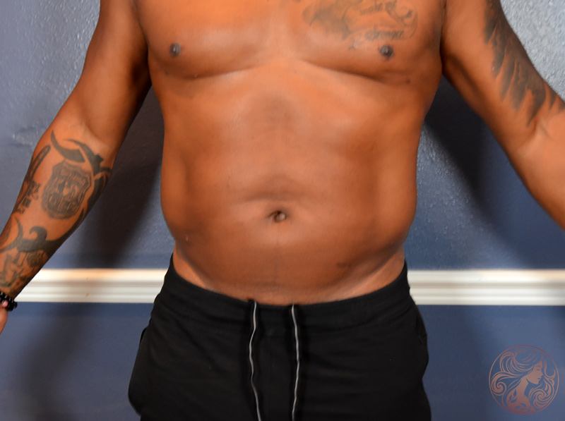 Liposuction body contouring, after treatment, front view showing a slimmer abdomen and improved waist definition. Viradia Plastic Surgery.