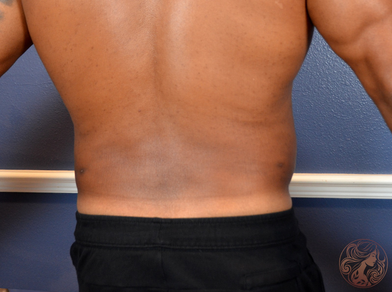 Liposuction body contouring, after treatment, angled view showing a more contoured waistline and smoother torso transition. Viradia Plastic Surgery.