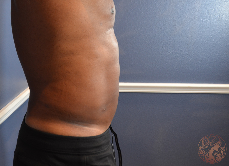 Liposuction body contouring, after treatment, angled rear view showing improved contour along the flanks and back. Viradia Plastic Surgery.