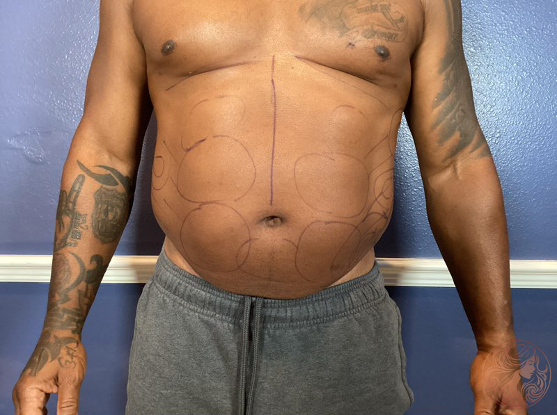 Liposuction body contouring, before treatment, front view showing excess fat in the abdomen and waistline. Viradia Plastic Surgery.