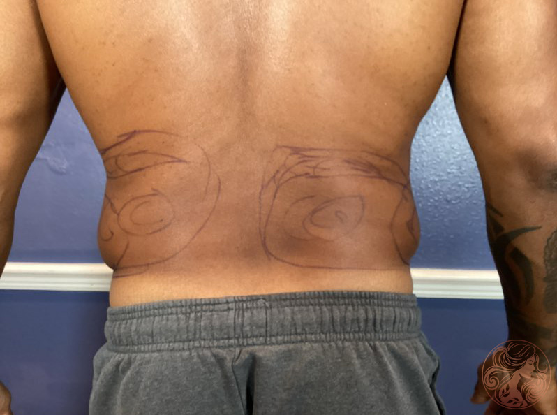 Liposuction body contouring, before treatment, angled view showing fullness in the abdomen and flanks. Viradia Plastic Surgery.