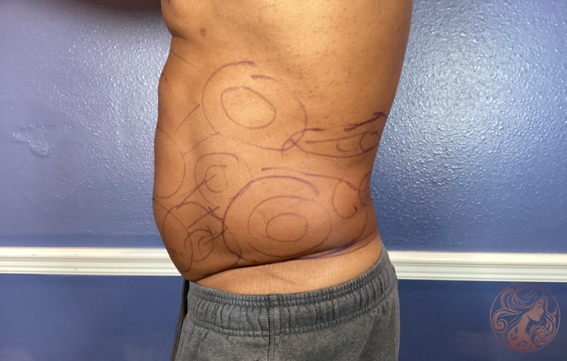 Liposuction body contouring, before treatment, side view showing abdominal fullness and lack of waist definition. Viradia Plastic Surgery.