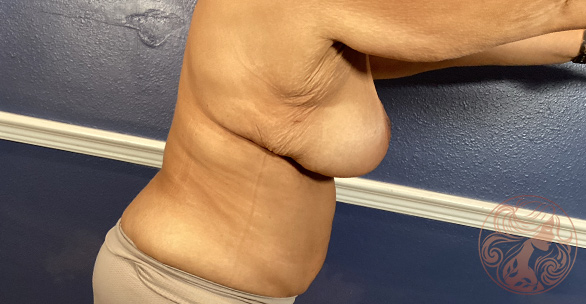 Breast lift with internal mesh support, after treatment, side view showing elevated breast position, improved projection, and a more youthful contour. Viradia Plastic Surgery.