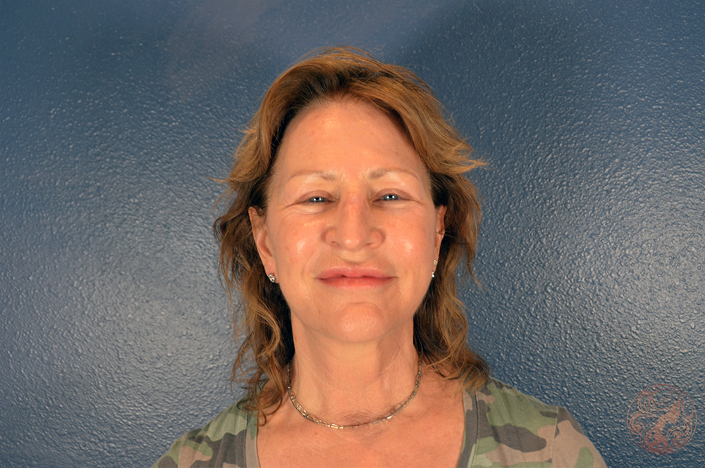 Deep plane facelift with neck lift, chin and neck liposuction, and CO2 laser resurfacing, after treatment, front view showing a more defined jawline, smoother neck contour, and brighter skin tone. Viradia Plastic Surgery.