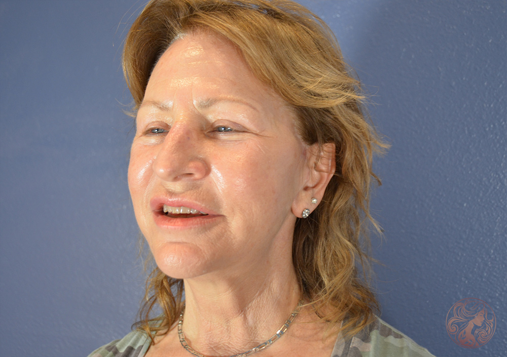 Deep plane facelift with neck lift, chin and neck liposuction, and CO2 laser resurfacing, after treatment, side view showing a more sculpted jawline, improved neck definition, and smoother skin. Viradia Plastic Surgery.