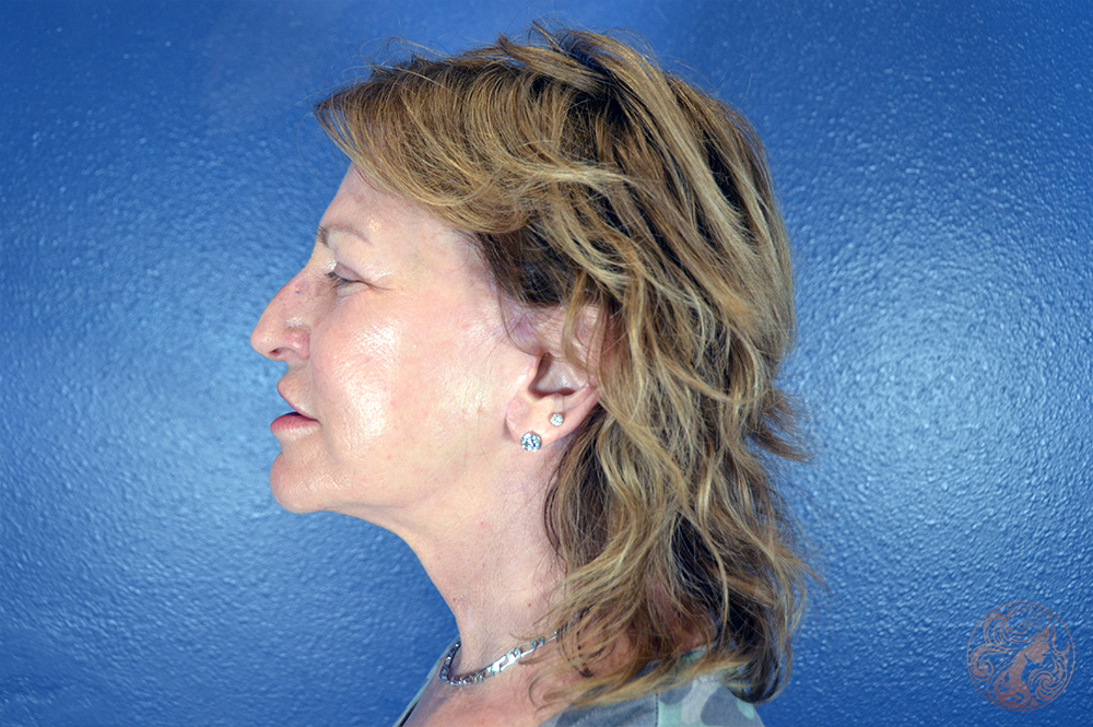 Deep plane facelift with neck lift, chin and neck liposuction, and CO2 laser resurfacing, after treatment, angled view showing improved lower facial contour, smoother neck transition, and brighter skin texture. Viradia Plastic Surgery.