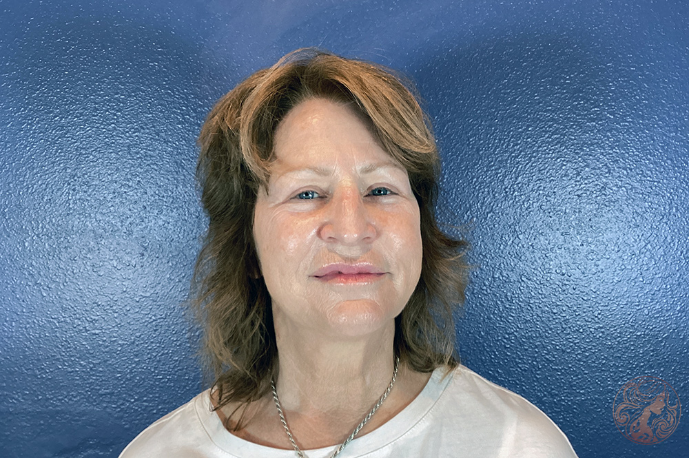 Deep plane facelift with neck lift, chin and neck liposuction, and CO2 laser resurfacing, before treatment, front view showing lower facial laxity, fullness beneath the chin, and visible skin texture changes. Viradia Plastic Surgery.