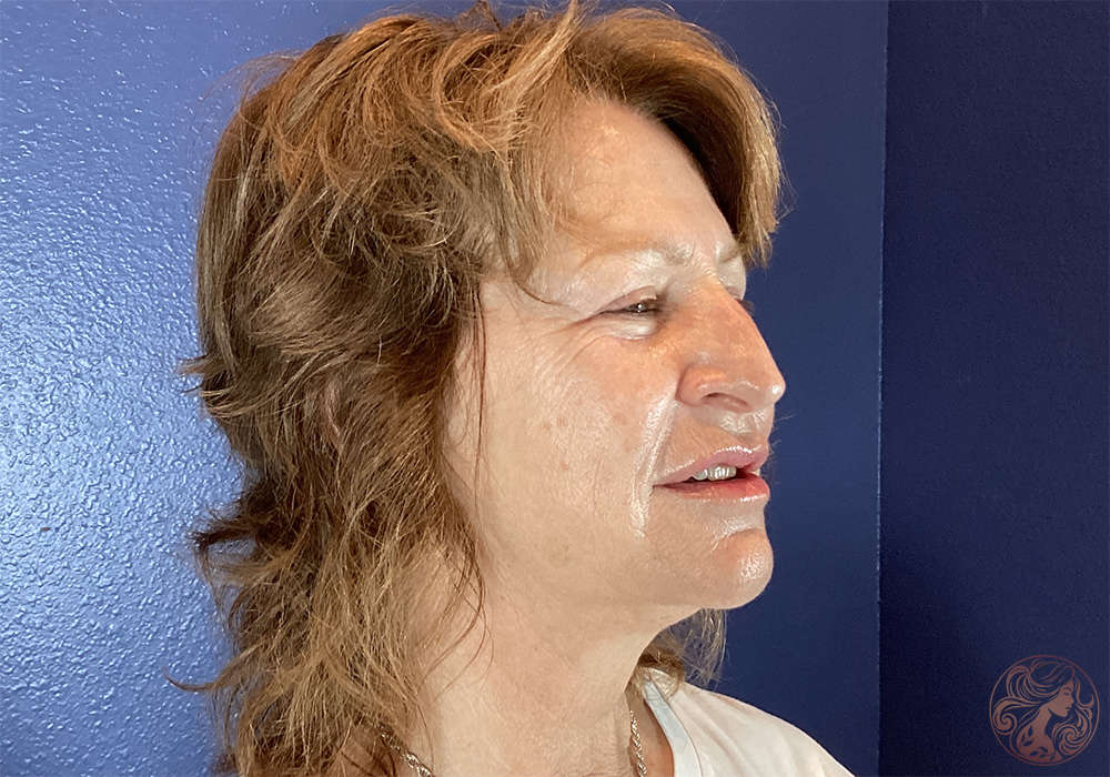 Deep plane facelift with neck lift, chin and neck liposuction, and CO2 laser resurfacing, before treatment, angled view showing facial laxity, softening along the jawline, and neck fullness. Viradia Plastic Surgery.