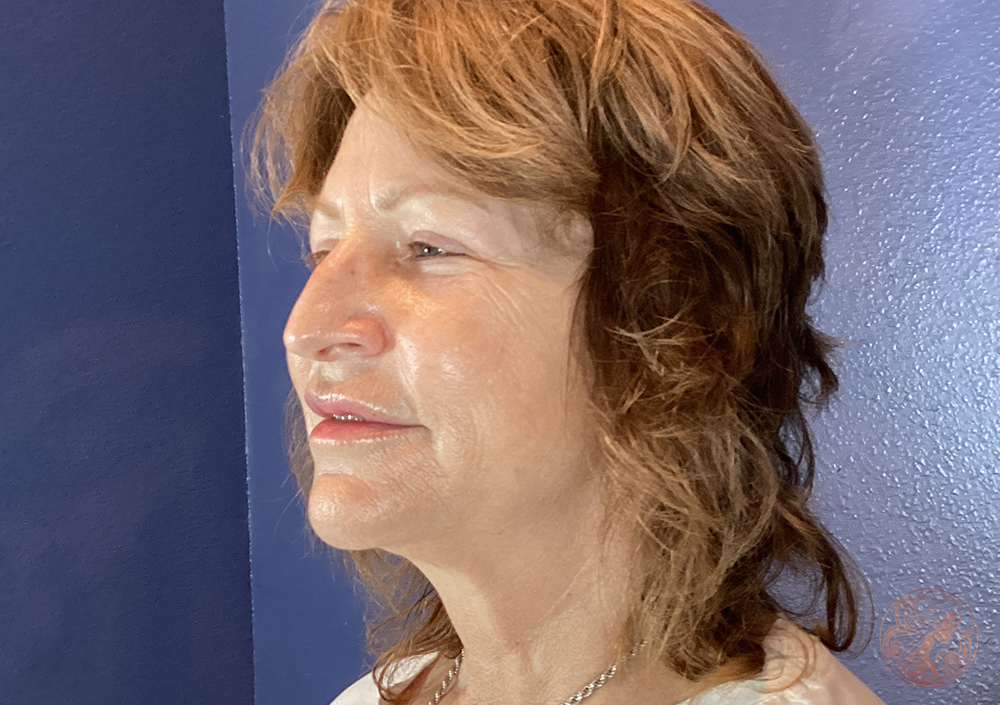 Deep plane facelift with neck lift, chin and neck liposuction, and CO2 laser resurfacing, before treatment, side view showing jawline laxity, fullness beneath the chin, and neck sagging. Viradia Plastic Surgery.