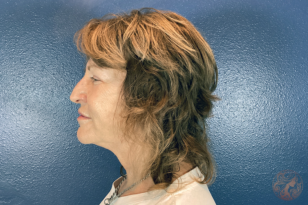 Deep plane facelift with neck lift, chin and neck liposuction, and CO2 laser resurfacing, before treatment, angled view showing lower facial descent, chin fullness, and skin quality changes. Viradia Plastic Surgery.