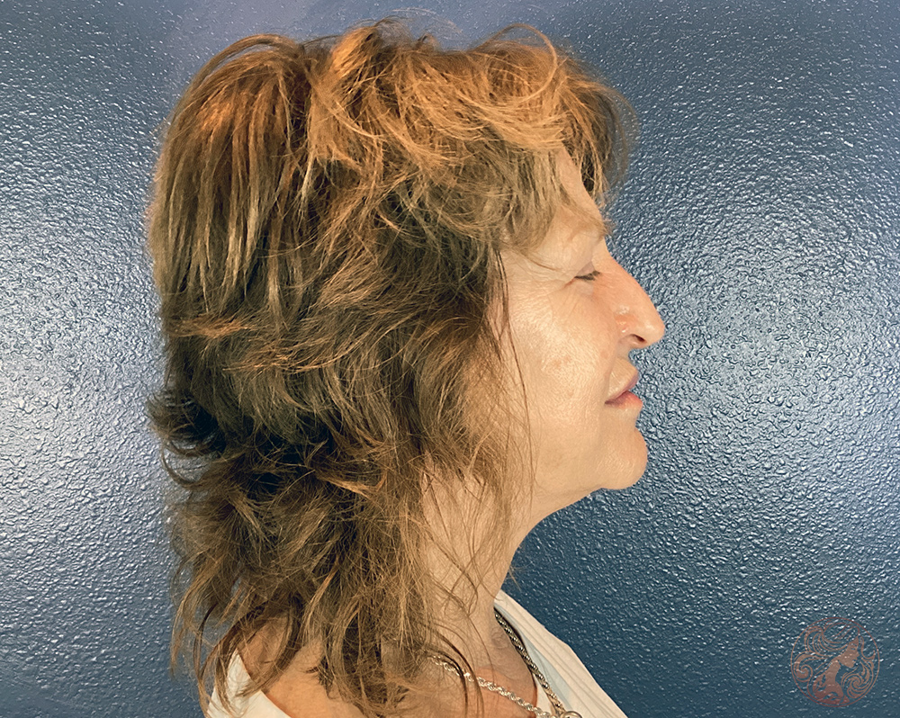 Deep plane facelift with neck lift, chin and neck liposuction, and CO2 laser resurfacing, before treatment, side view showing facial laxity, neck fullness, and uneven skin texture. Viradia Plastic Surgery.