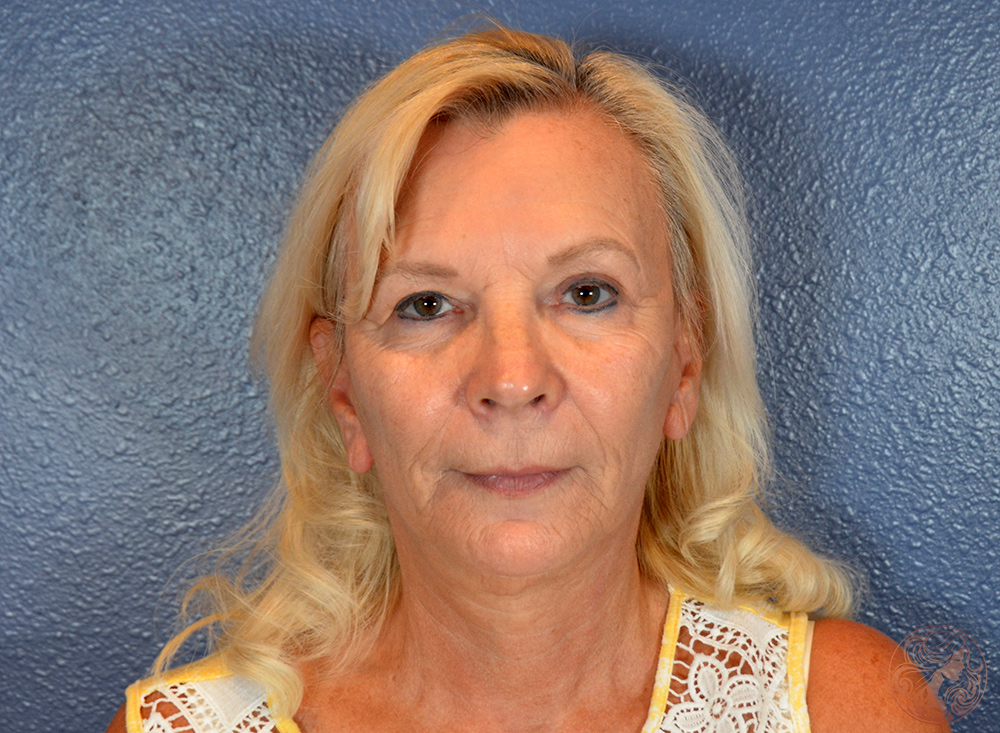 Deep plane facelift with neck lift, blepharoplasty, neck liposuction, and facial fat grafting, after treatment, front view showing a smoother jawline, more open eyes, restored facial volume, and a refreshed natural appearance. Viradia Plastic Surgery.