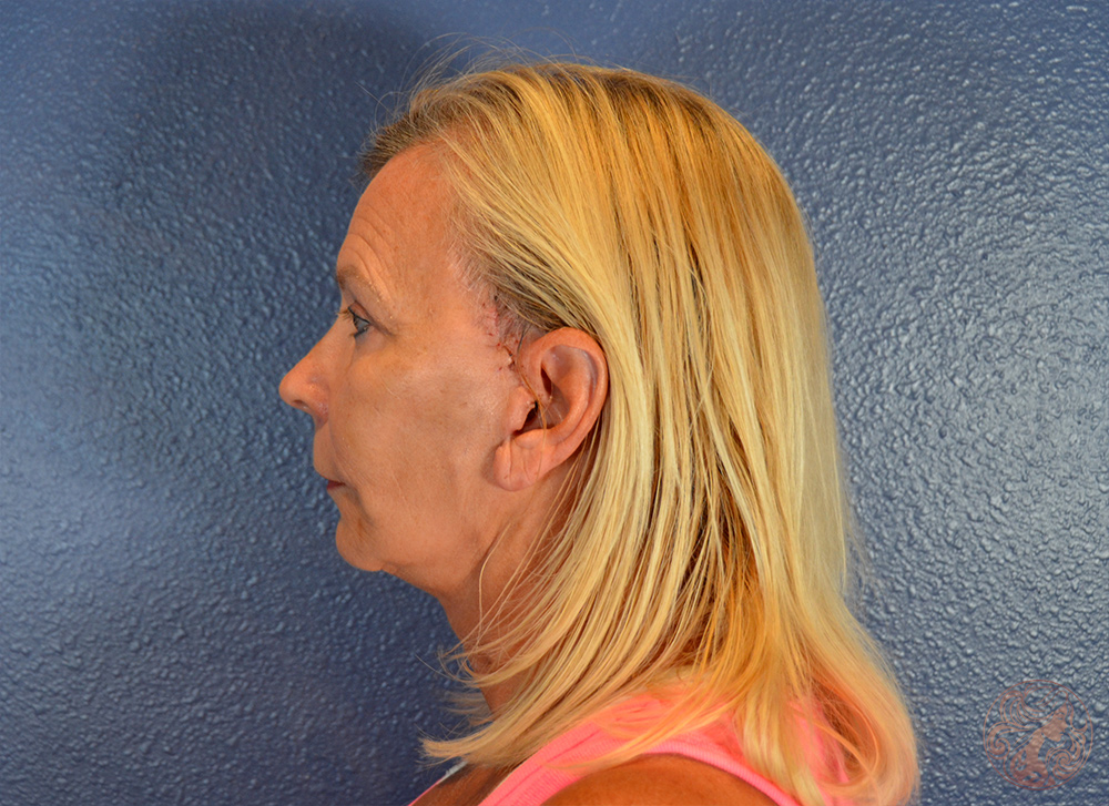 Deep plane facelift with neck lift, blepharoplasty, neck liposuction, and facial fat grafting, after treatment, side view showing improved jawline definition, smoother neck contour, brighter eyes, and restored facial fullness. Viradia Plastic Surgery.