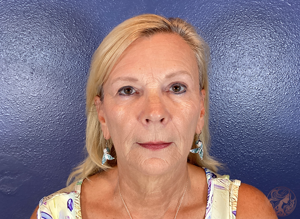 Deep plane facelift with neck lift, blepharoplasty, neck liposuction, and facial fat grafting, before treatment, front view showing midface sagging, jawline laxity, fullness beneath the chin, eyelid heaviness, and facial volume loss. Viradia Plastic Surgery.