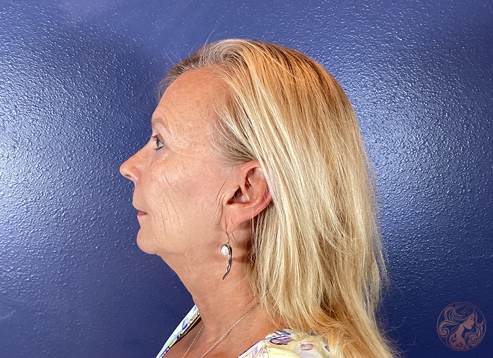 Deep plane facelift with neck lift, blepharoplasty, neck liposuction, and facial fat grafting, before treatment, side view showing facial descent, neck fullness, eyelid laxity, and loss of cheek volume. Viradia Plastic Surgery.