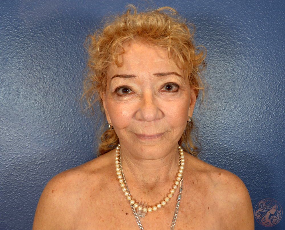 Deep plane facelift with neck lift and upper blepharoplasty, after treatment, front view showing a refined jawline, smoother contours, and more open eyes. Viradia Plastic Surgery.