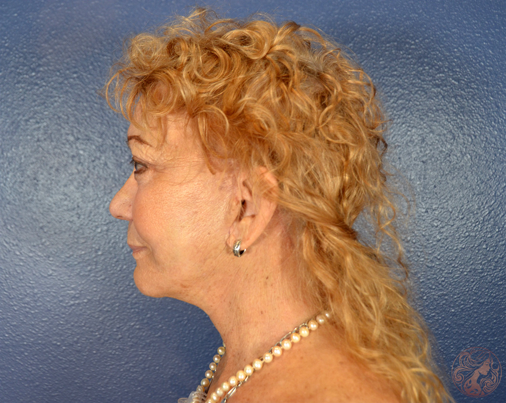 Deep plane facelift with neck lift and upper blepharoplasty, after treatment, side view showing improved jawline definition, smoother neck contour, and more open eye appearance. Viradia Plastic Surgery.