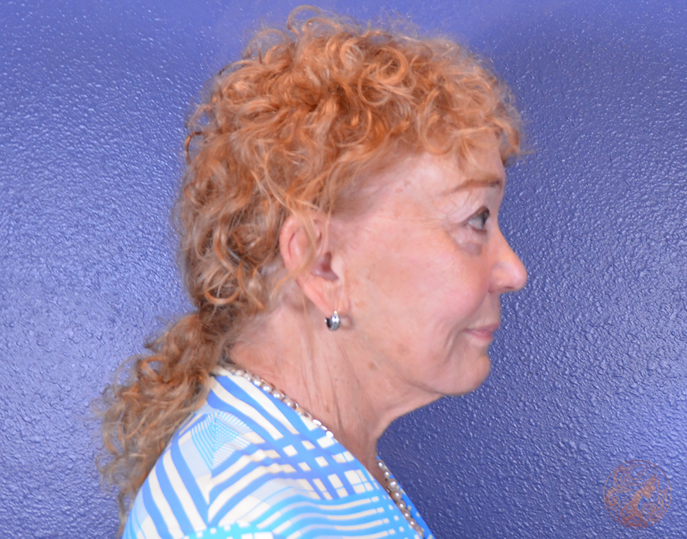 Deep plane facelift with neck lift and upper blepharoplasty, before treatment, angled view showing midface descent and loss of jawline definition. Viradia Plastic Surgery.