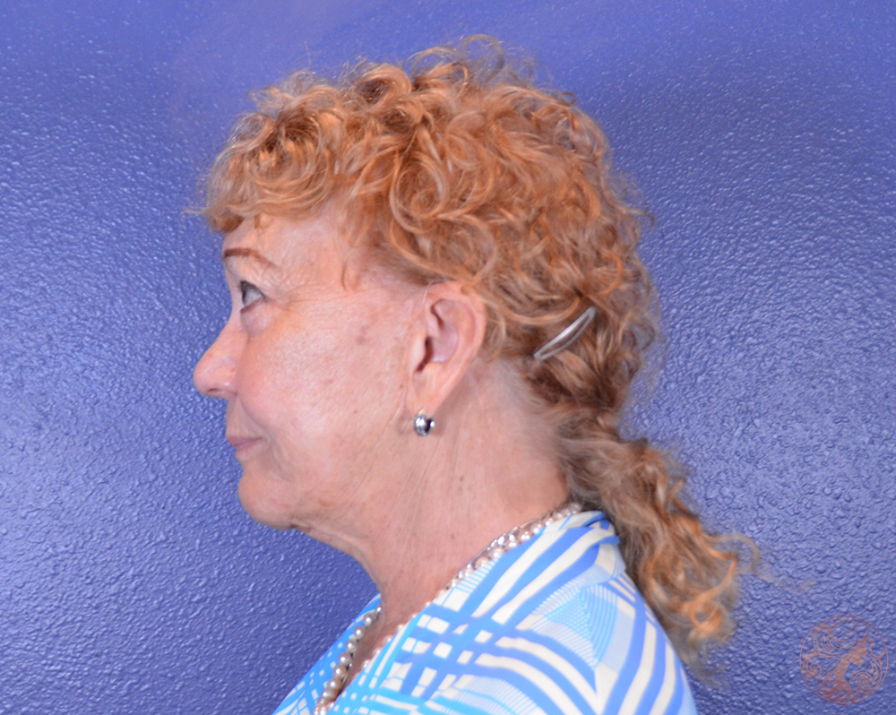Deep plane facelift with neck lift and upper blepharoplasty, before treatment, side view showing sagging along the jawline, neck fullness, and upper eyelid heaviness. Viradia Plastic Surgery.