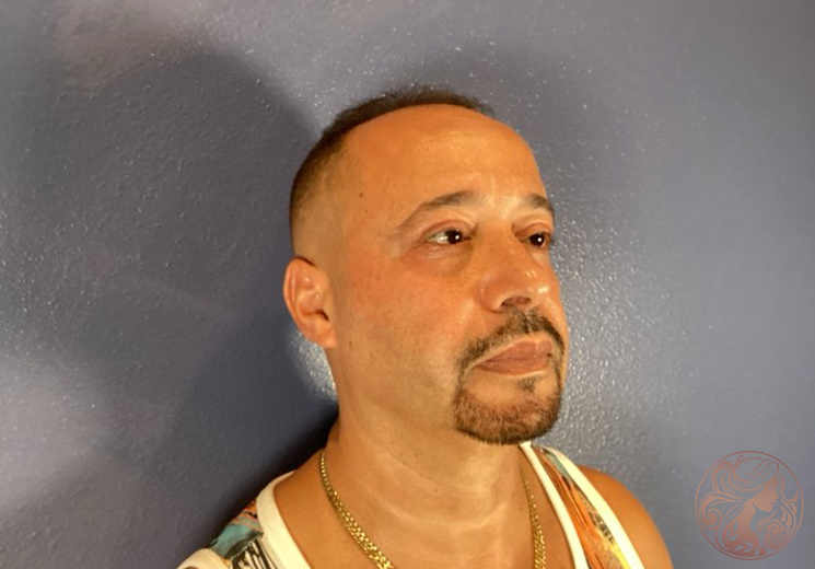 Upper and lower blepharoplasty, after treatment, front view showing smoother eyelids and a more refreshed, rested appearance. Viradia Plastic Surgery.