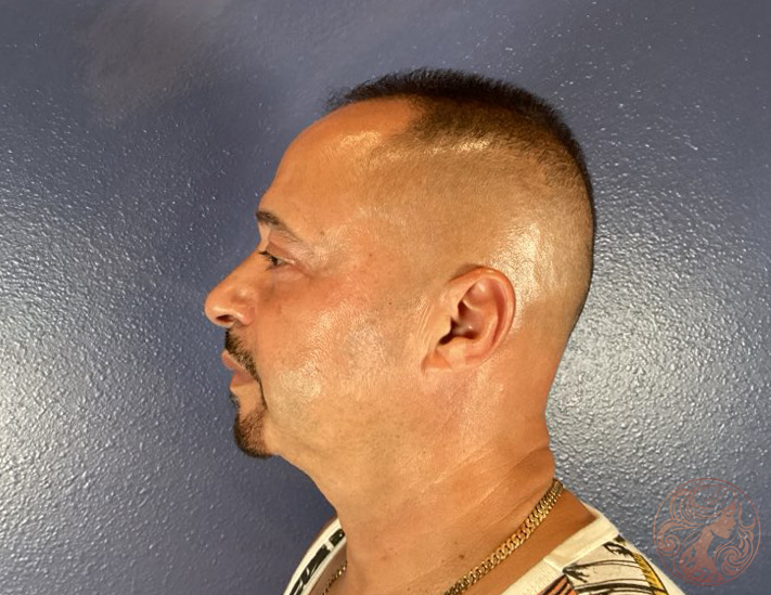 Upper and lower blepharoplasty, after treatment, side view showing smoother eyelid contour and improved eye definition. Viradia Plastic Surgery.