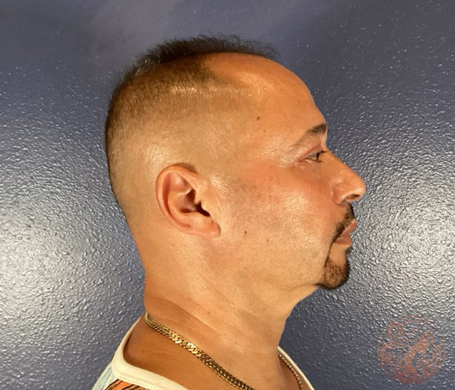 Upper and lower blepharoplasty, after treatment, angled view showing smoother eyelids and reduced under-eye fullness. Viradia Plastic Surgery.